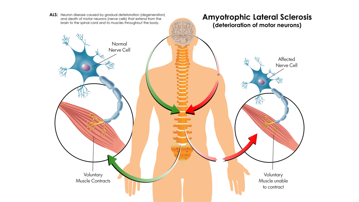 Amyotrophic Lateral Sclerosis ALS Signs Causes Prognosis Los Angeles Times